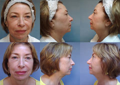 http://www.mixtoskinresurfacing.com/images/dr_gregory_patient_sample.jpg